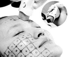 Non Surgical RF Face Lifting Acne Removal Machine For Skin Rejuvenation